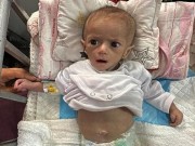 "أونروا": 66 ألف طفل بغزة يعانون من سوء تغذية خطير