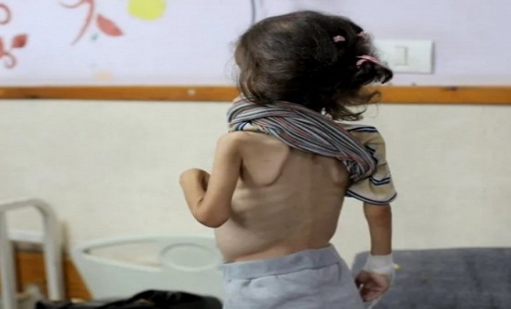 أونروا: أكثر من 2700 طفل في غزة أصيبوا بسوء تغذية حاد