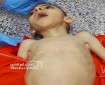 استشهاد طفل بغزة جراء سوء التغذية