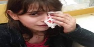 إصابة طفلة في عينها عقب اعتداء مستوطن عليها في القدس